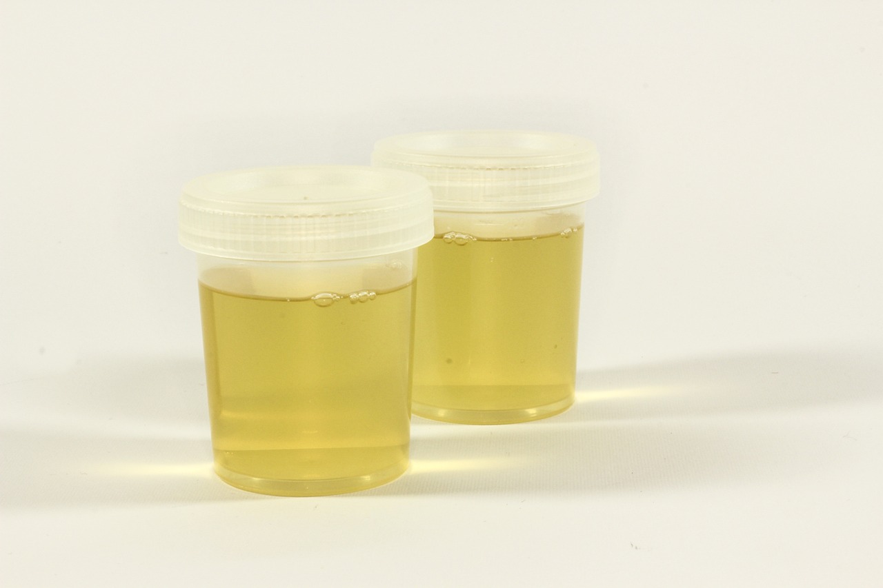 test, a container for urine, urine, inflammation, analysis, medical, lab, test tube, diagnostics, tests, the doctor, hospital, medic, download, urine, urine, urine, urine, urine